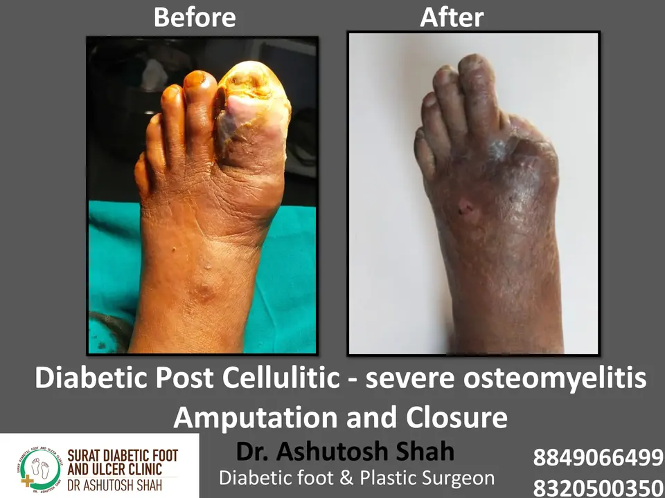 Diabetic Foot  PPT sunita.pptx-6.webp